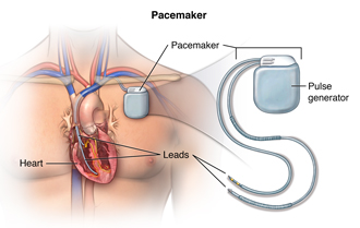 ECG